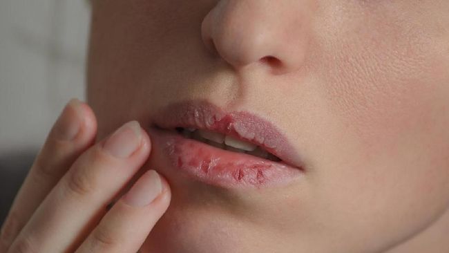 7 Cara Mengatasi Bibir Kering Selain Menggunakan Pelembab Bibir